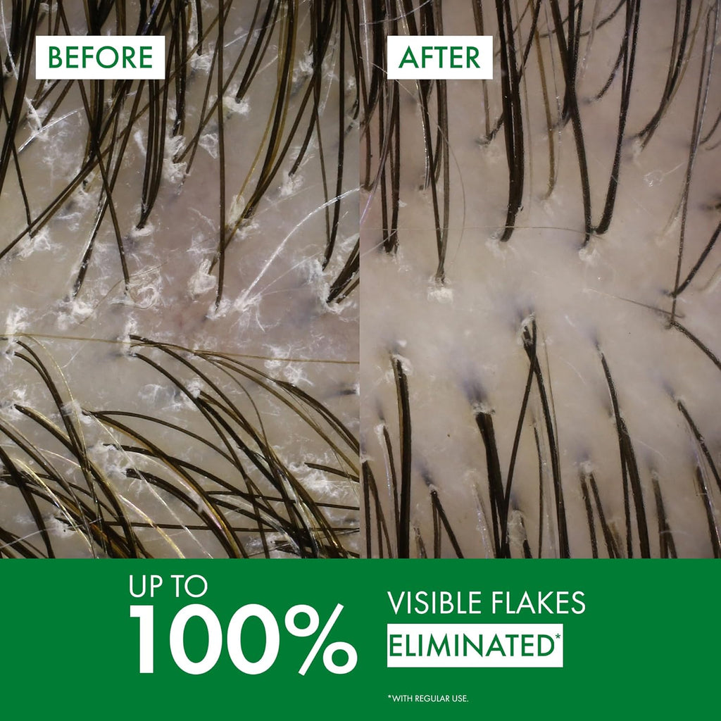 Vichy Dercos Anti-Dandruff Shampoo – Selenium Sulfide Dry Scalp Relief & Flake Control Treatment