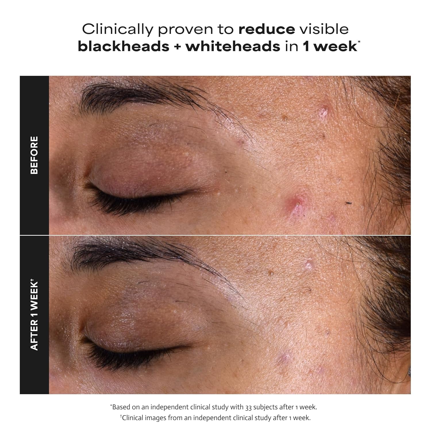 Paula’s Choice 2% BHA Liquid Exfoliant – Salicylic Acid Pore Minimizing Toner for Clear, Smooth Skin