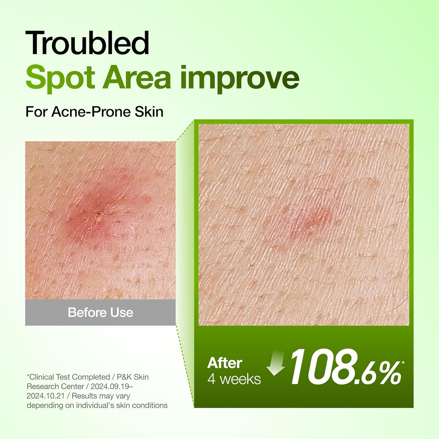 Anua Azelaic Calm Serum 10% – Redness Relief, Blemish Care & Oil Control Treatment