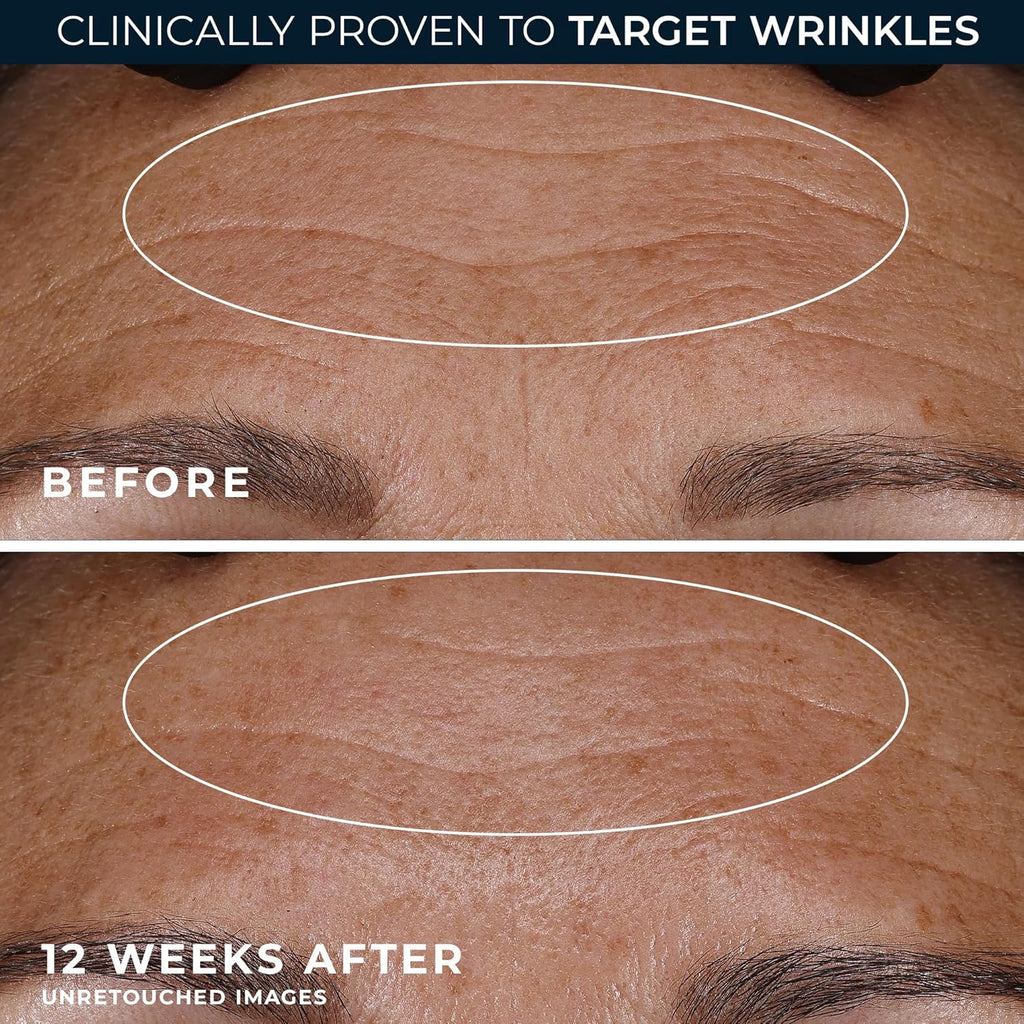 RoC Retinol Renewal Night Cream – Deep Wrinkle Repair & Firming Moisturizer