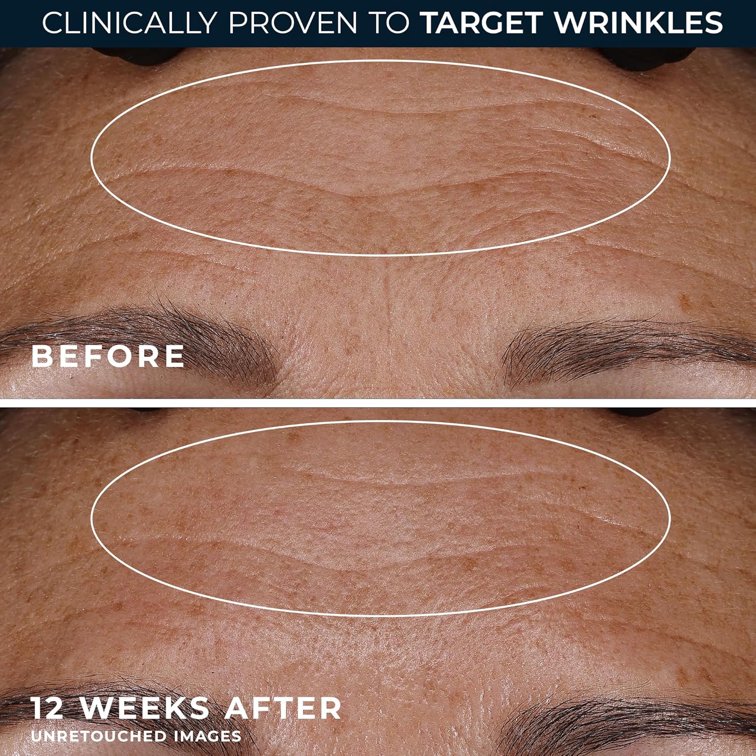 RoC Retinol Renewal Night Cream – Deep Wrinkle Repair & Firming Moisturizer
