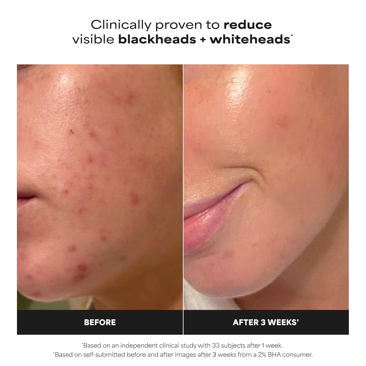 Paula’s Choice 2% BHA Liquid Exfoliant – Salicylic Acid Pore Minimizing Toner for Clear, Smooth Skin